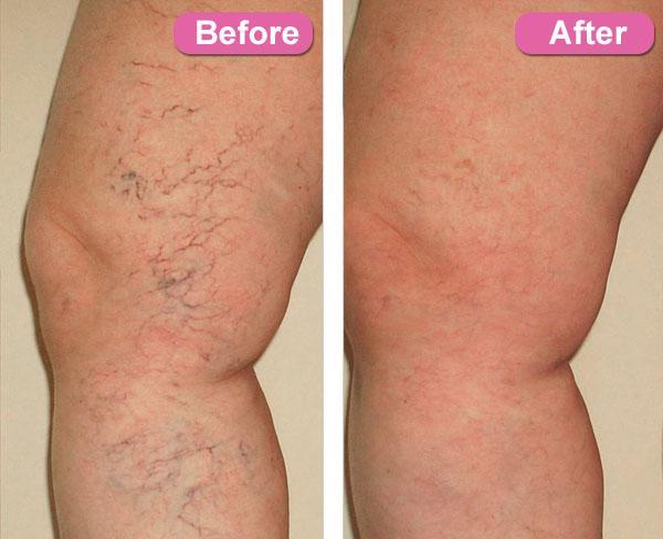 Varicose Veins Treatment Cream