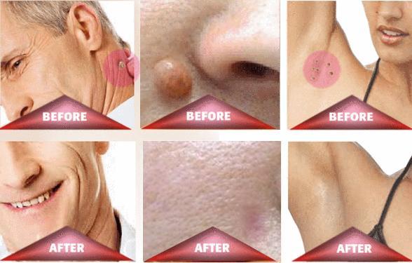 Skin Tag Remover