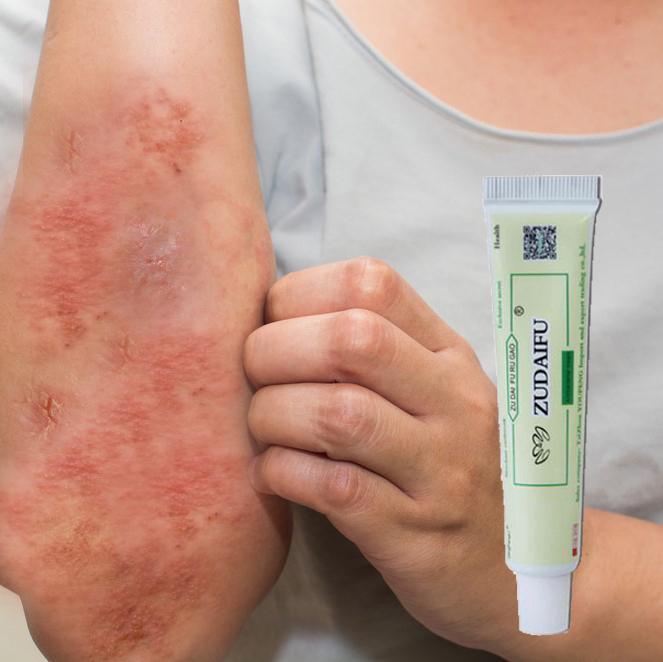 Herbal Eczema Cream