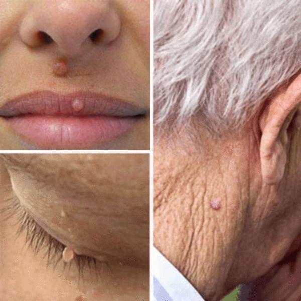 Skin Tag Remover