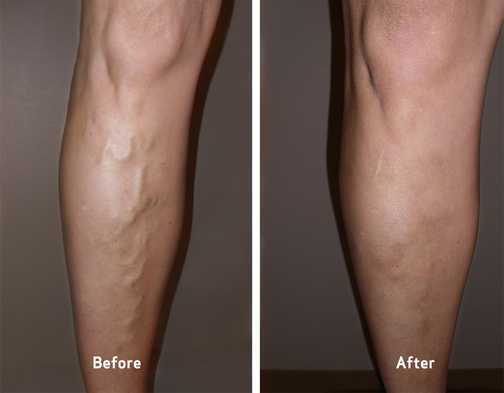 Varicose Veins Treatment Cream