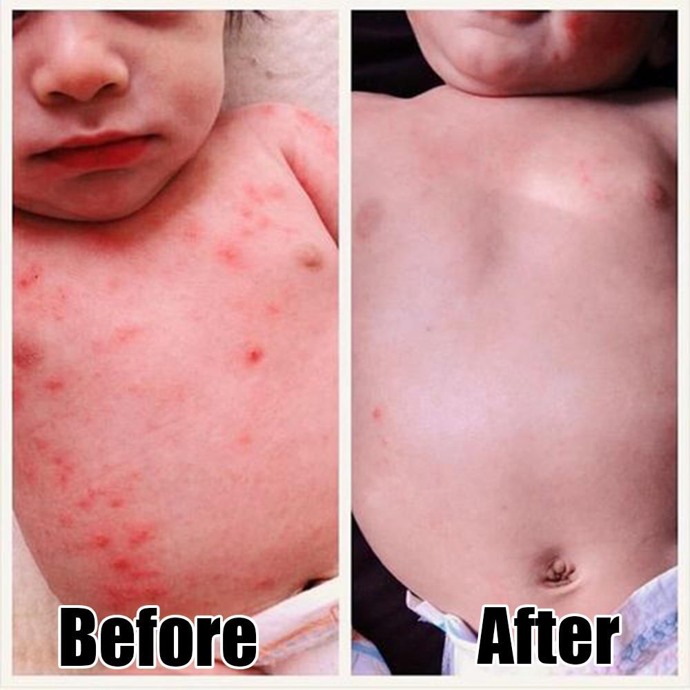 Herbal Eczema Cream