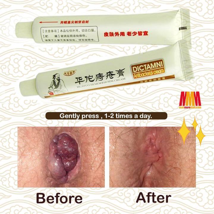Chinese Herbal Hemorrhoids Cream