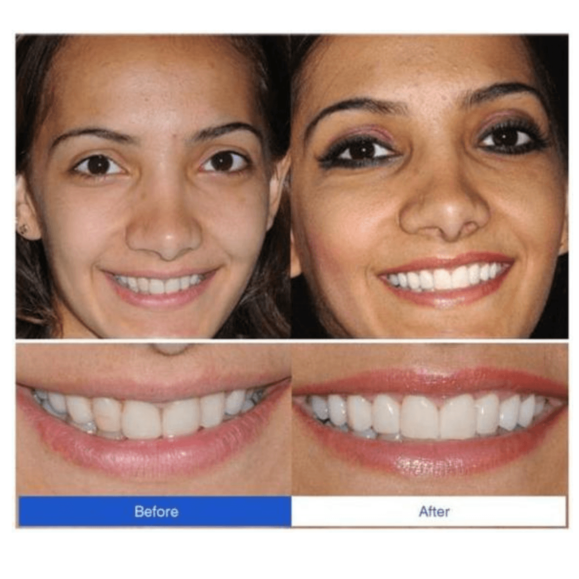 Perfect Smile Snap On Braces