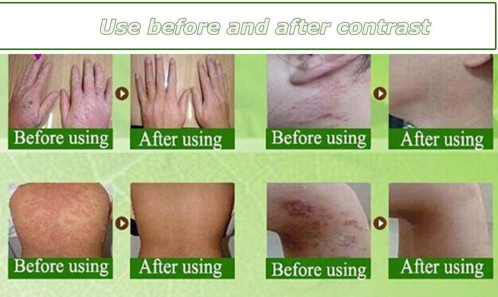 Herbal Eczema Cream