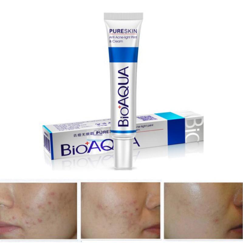Body Acne Treatment Cream