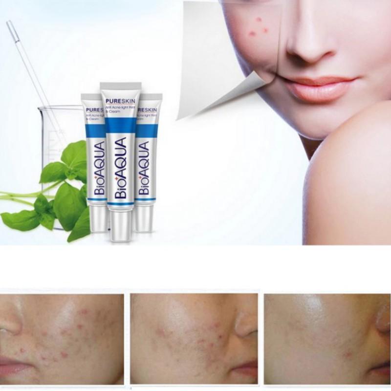 Body Acne Treatment Cream