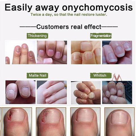 Nail Treatment Cream