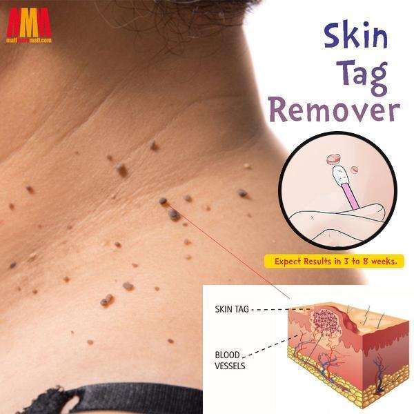 Skin Tag Remover